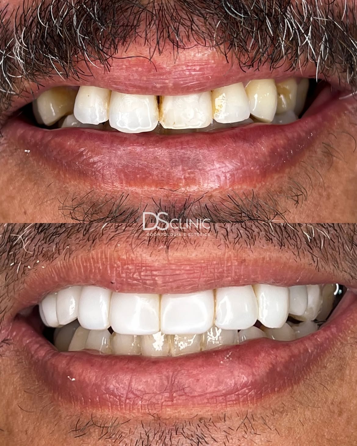 Facetas em resina no Eusébio: antes e depois de um sorriso masculino renovado